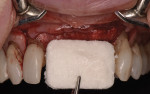 Fig 20. Use of a collagen scaffold at the time of implant placement to improve soft-tissue contours.