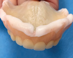 Fig 8. Post-denture delivery 2-day appointment. The patient reported wearing the denture comfortably, noting one small sore spot. A new tissue conditioning soft liner (Coe-Comfort™, GC America) was placed and would remain in use for 1 month, followed by a soft reline to complete the healing for the final 3 months.