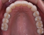(14.) The maxillary arch post-treatment.