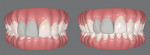 Fig 3. Both arches were scanned. Teeth Nos. 7 and 8 were added virtually in the
software. After patient approval, the digital proposal of the orthodontic treatment plan was finished in 40 weeks (left, pre-orthodontics; right,
post-orthodontics).