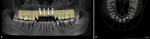 Fig 7. The implant plan showing the merged model and proposed implant crowns with the CBCT. Implants were placed
virtually at the planned sites based on the patient’s 3D anatomy. Surgical guide (not shown) was designed to achieve those planned positions.