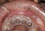 Fig 9. Occlusal view of surgical guide.