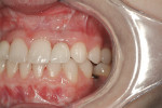 Figure 34  Frontal view of the definitive maxillary implant restorations at the day of insertion and cementation.