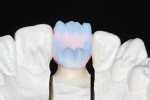 Figure 9: Incisal porcelain applied in an uneven manner with porcelain build-up of the lingual cingulum to correspond with the natural dentition depicted on the working model.
