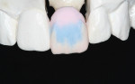 Figure 11  Opal Translucent incisal is applied between the incisal lobes and the interproximals.