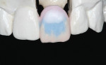 Figure 12  White Opal Incisal is applied to the cervical one-third to highlight the contour of the restoration.