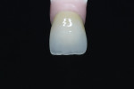 Figure 25  The build-up of shade A1 with incisal translucency, Coral modifier, and an incisal halo.