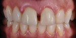 Figure 11  One week post-op illustrates a nice tissue response, providing the dentist and technician with a positive restorative foundation.