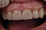 Figure 16  Once cemented, the junction must be smoothed intraorally by the dentist to have a smooth transition from restoration to tooth.