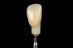 (11.) Extraoral view of the definitive restoration, which was fabricated from zirconia and layering ceramics.