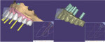 (7.) Design views of the provisional hybrid prosthesis on the virtual model (left) and with the model removed and implant analogs present (right).