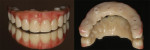 (10.) Extraoral views of the 3D printed and stained provisional hybrid prosthesis ready for insertion.