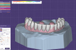 Fig 14. Once the tooth setup was done, the gingival contours were developed.