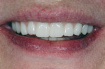 Fig 22. Although a monolithic resin material was used, the esthetics were well received by the patient.