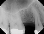 Fig 3. Preoperative periapical radiograph.