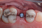 Fig 10. Occlusal view of the single implant
after placement.