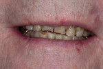 Fig 9. Pretreatment close-up view of patient’s full smile.