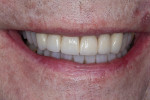 Fig 15. Post-treatment close-up view of patient’s full smile.