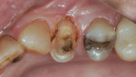 After preparation, gingival tissue around fractured tooth
No. 12 has been recontoured using the DentaLaze to expose
margins for good visualization prior to impression
(dentistry by Dr. Duplantis).