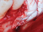 Fig 6. Close-up view of stabilizing sutures looped around the most
anterior fixation screw.