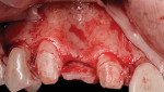 Fig 12. (Case 2) Full-thickness flap-releasing incision at the mesial line angle of the maxillary right lateral incisor to premolar to expose the canine
region; note severe horizontal ridge deficiency.