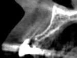 Fig 13. Preoperative CBCT view, maxillary right lateral incisor.
