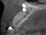 Fig 16. CBCT view of the maxillary right lateral incisor showing adequate bone
height and width to support implant placement.