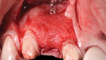 Fig 17. Full-thickness flap reflection, buccal view, showing osseous defect regeneration.