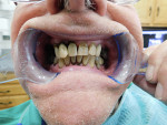 Fig 2. This patient wears maxillary and mandibular removable partial dentures. Due to a number of factors, the patient is at high risk for caries. Biannual applications of SDF have helped preserve existing dentition (photograph courtesy of Dan Bentley, DDS).