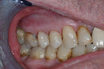 Fig 4. Following improved oral health status and arrest of carious lesions with SDF, the patient (same patient as shown in Fig 3) was eligible for resin composite restoration of teeth Nos. 4 and 5. Conservative preparation focused on enamel margins and DEJ; much of the hardened, SDF-darkened axial walls were preserved. RMGI liner was used to opaque axial walls, then restoration was done with nanohybrid resin composite using etch-and-rinse bonding technique. Also note the glass-ionomer restoration on the mesial of tooth No. 30 (photograph courtesy of Dan Bentley, DDS). (This image was originally published in: Young DA, Quock RL, Horst J, et al. Clinical instructions for using silver diamine fluoride (SDF) in dental caries management. Compendium of Continuing Education in Dentistry. 2021 June;42(6). Copyright © 2023 to BroadcastMed LLC. All rights reserved. Used with permission of the publisher.)