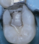 Fig 7. Five months later, the patient was still asymptomatic and the oral health status was stabilized. Tooth No. 19 was eligible for a resin composite restoration. Conservative preparation focused on enamel margins and DEJ; note that glass-ionomer was retained as a base to opaque the arrested underlying SDF-treated dentin.