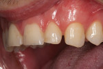 Figure 7  The patient’s right side dentition, close-up and retracted.