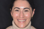 Fig 1. Pretreatment full-face smile. Note hypermobile lip, excessive gingival
display, canted smile, and discolored restorations.