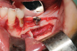 Fig 6. Implant insertion in the tooth No. 19 position.