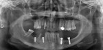 Fig 7. Panoramic radiograph, post-surgery, showing implants in the positions
of teeth Nos. 19 and 21.