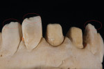 Fig 2. A close look at the model reveals visible chips on teeth Nos. 6, 10, and 11.