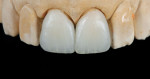 Fig 11 and Fig 12. Only one stain is used to apply the incisal effects.