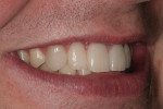 Figure 24  A left-side view of the patient’s postoperative smile.