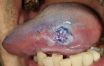 Fig 2. Appearance of the lesion after toluidine blue staining.