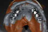 Figure 13  (Case 2) Clinical presentation of No. 7 implant. Note discrepancy in crown length due to bruxism.