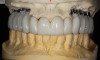 Figure 15  (Case 2) Defect after implant removal.
