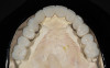 Figure 16  (Case 2) Defect grafted with mineralized freeze-dried bone allograft.