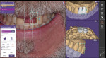 (3. AND 4.) With the photograph overlayed over the scan, critical information about the patient’s lips, facial features, and smile were used to design his proposed smile.
