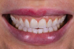 (2.) Pretreatment full smile photograph displaying retroclined maxillary teeth and collapsed buccal corridors.