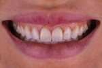 (6.) Full smile photograph acquired after the completion of clear aligner treatment but before the restorative treatment demonstrating how the teeth have been uprighted, the buccal corridors are fuller, and there is now room in the anterior to lengthen the teeth.