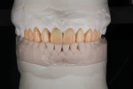 (7.) Analog wax-up of the smile design of teeth Nos. 4 through 13 (designed by Myung Joo Shin at Synergy Ceramics).
