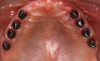 Figure 31  Final restorations in place. These are screw-retained to avoid cementation of deepened implant restorations.