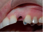 Fig 8. Buccal view of the implant placed following extraction of the deciduous canine.