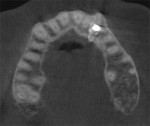 Fig 19. CBCT axial view at 3-years 8-months post–implant placement demonstrating the apical portion of the implant in relation to the supernumerary teeth and maintenance of bone.