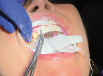 (19.) Intraoral view of the provisional restorations being removed.